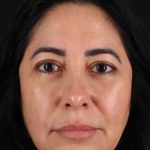 Upper Blepharoplasty Before & After Patient #3456