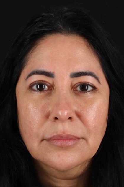 Upper Blepharoplasty Before & After Patient #3456