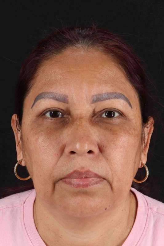 Upper Blepharoplasty Before & After Patient #3467
