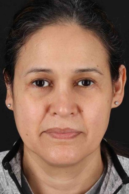 Upper Blepharoplasty Before & After Patient #3489
