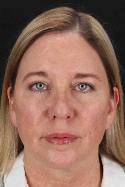 Upper Blepharoplasty Before & After Patient #3500