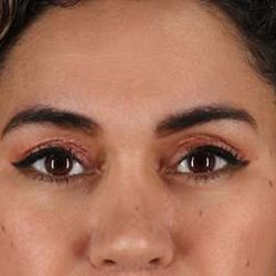Upper Blepharoplasty Before & After Patient #3522