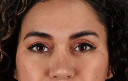 Upper Blepharoplasty Before & After Patient #3522