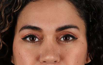 Upper Blepharoplasty Before & After Patient #3522