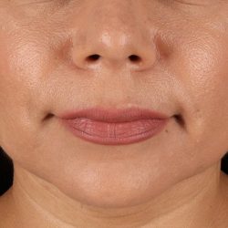 Facelift Before & After Patient #3555