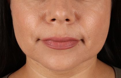 Facelift Before & After Patient #3555