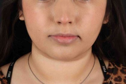 Buccal Fat Pad Before & After Patient #1469