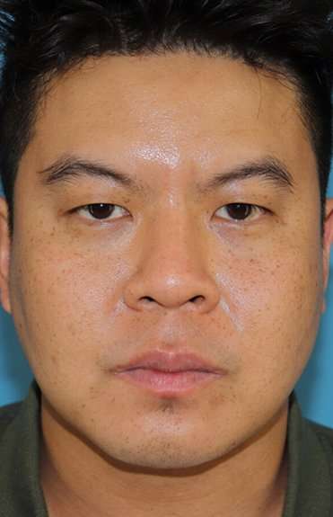 Buccal Fat Pad Before & After Patient #1474