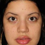 Buccal Fat Pad Before & After Patient #1485