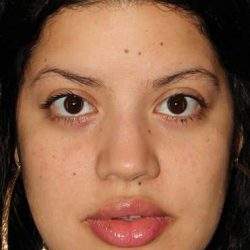 Buccal Fat Pad Before & After Patient #1485