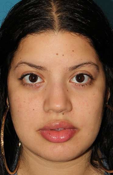 Buccal Fat Pad Before & After Patient #1485