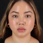 Chin Implant Before & After Patient #1507