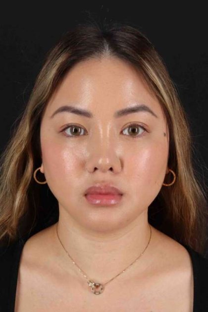 Chin Implant Before & After Patient #1507