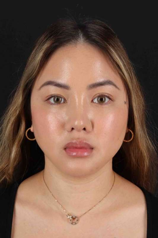 Chin Implant Before & After Patient #1507