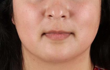 Chin Implant Before & After Patient #1529