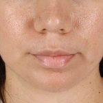 Chin Implant Before & After Patient #1540