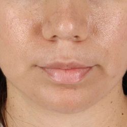 Chin Implant Before & After Patient #1540