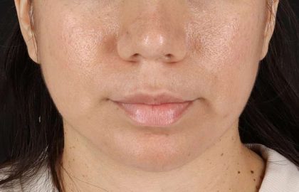 Chin Implant Before & After Patient #1540