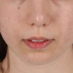 Chin Implant Before & After Patient #1551