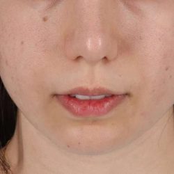 Chin Implant Before & After Patient #1551