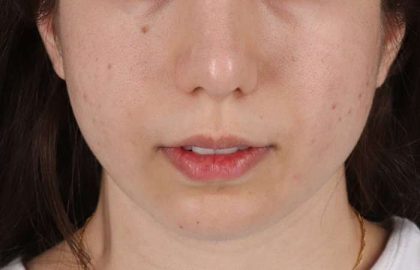 Chin Implant Before & After Patient #1551