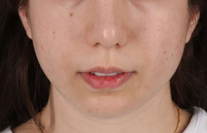 Chin Implant Before & After Patient #1551