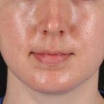 Chin Implant Before & After Patient #1562