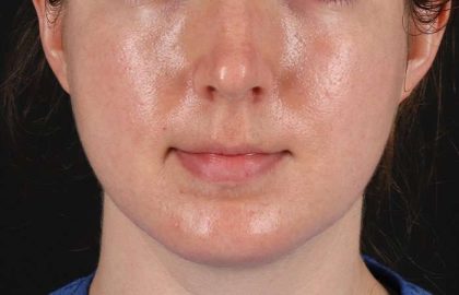 Chin Implant Before & After Patient #1562