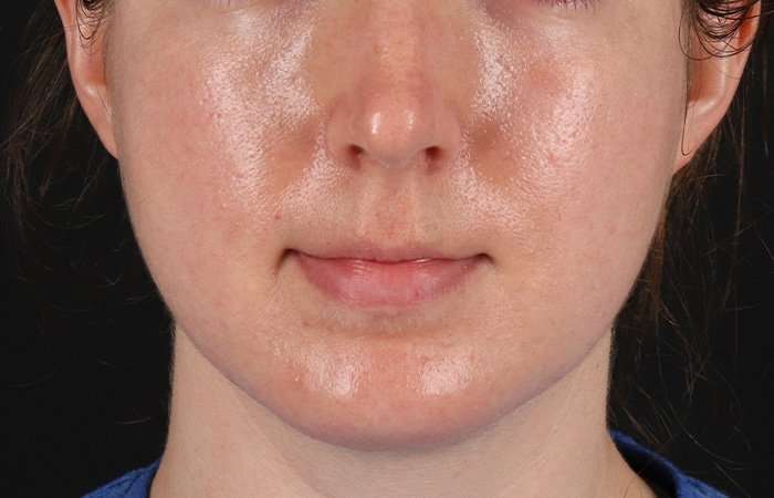 Chin Implant Before & After Patient #1562