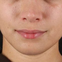 Chin Implant Before & After Patient #1573
