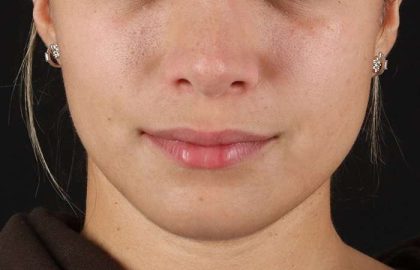 Chin Implant Before & After Patient #1573