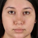 Chin Implant Before & After Patient #1604