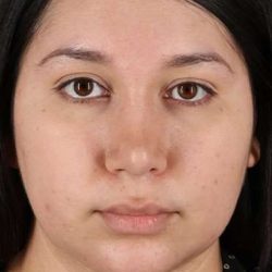 Chin Implant Before & After Patient #1604