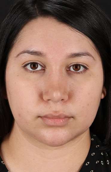 Chin Implant Before & After Patient #1604