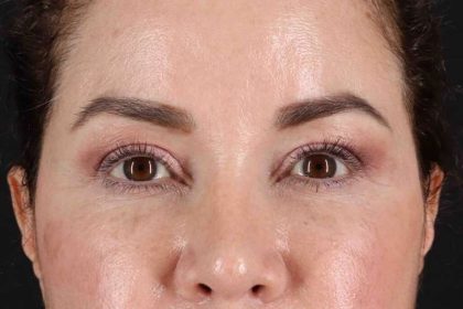 Browlift Before & After Patient #1253