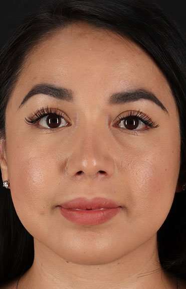 Chin Implant Before & After Patient #1626