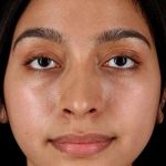 Chin Implant Before & After Patient #1637