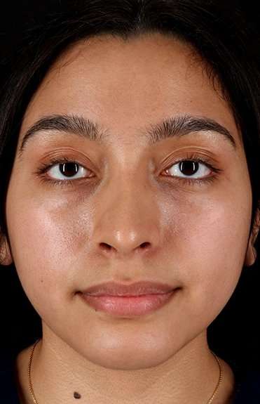 Chin Implant Before & After Patient #1637