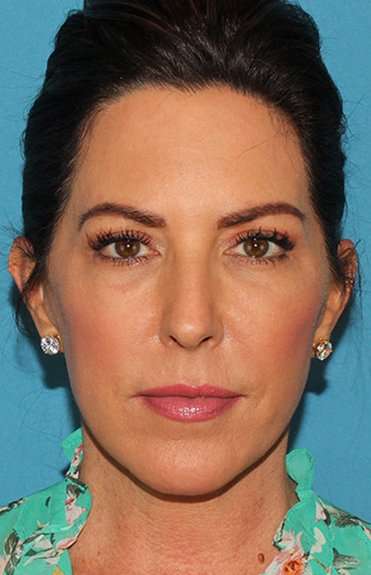 Chin Implant Before & After Patient #1659