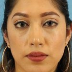 Chin Implant Before & After Patient #1670