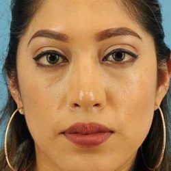 Chin Implant Before & After Patient #1670