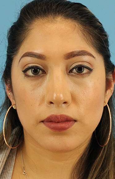 Chin Implant Before & After Patient #1670
