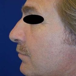 Chin Implant Before & After Patient #1673