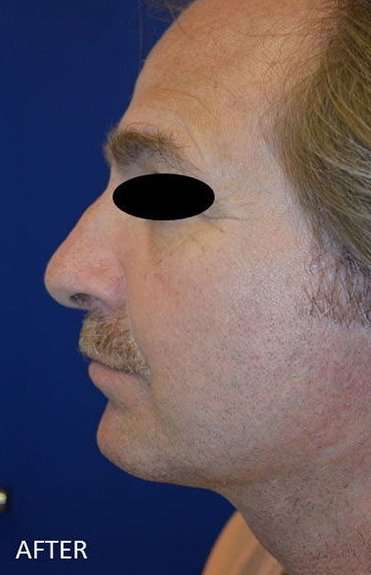 Chin Implant Before & After Patient #1673