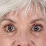 Eyelid Lift Before & After Patient #1676