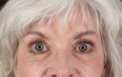 Eyelid Lift Before & After Patient #1676