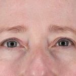 Eyelid Lift Before & After Patient #1679