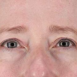 Eyelid Lift Before & After Patient #1679