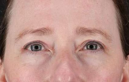 Eyelid Lift Before & After Patient #1679