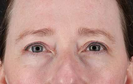 Eyelid Lift Before & After Patient #1679
